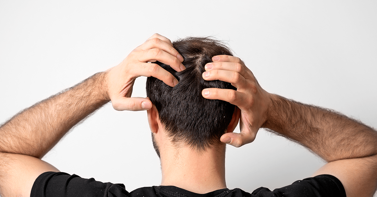 donorgebied na haartransplantatie