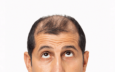 Is een haartransplantatie gevaarlijk?
